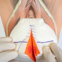 Mediolateral episiotomy repair trainer - patient's left side