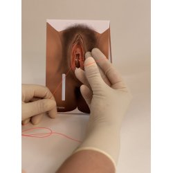 1st-degree repair model