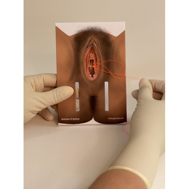 1st-degree repair model