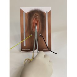 1st-degree repair model