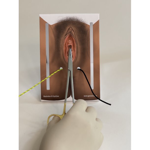 1st-degree repair model