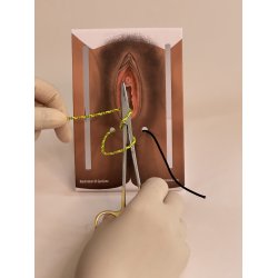 1st-degree repair model